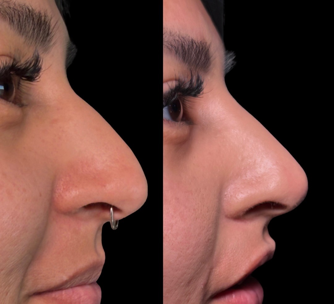 Nonsurgical rhinoplasty before and after at Tulua Medical in Gilbert, AZ — dorsal hump smoothed and tip lifted with HA filler.