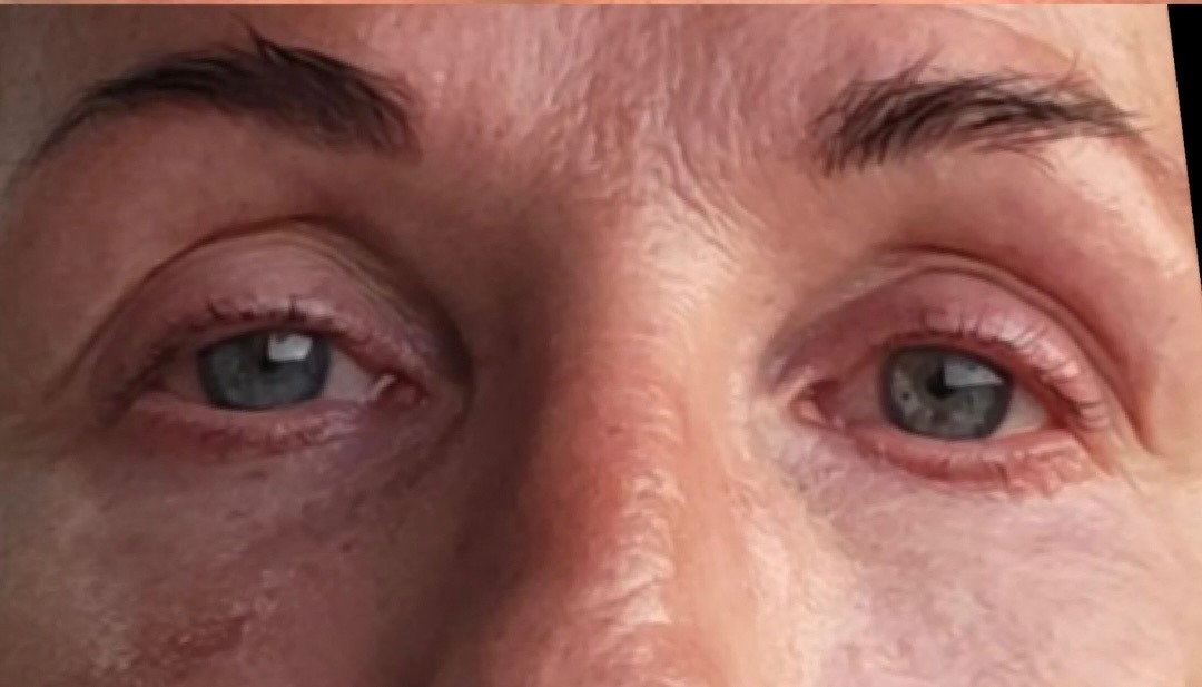 Tear trough & midface filler before and after — actual Tulua patient — after
