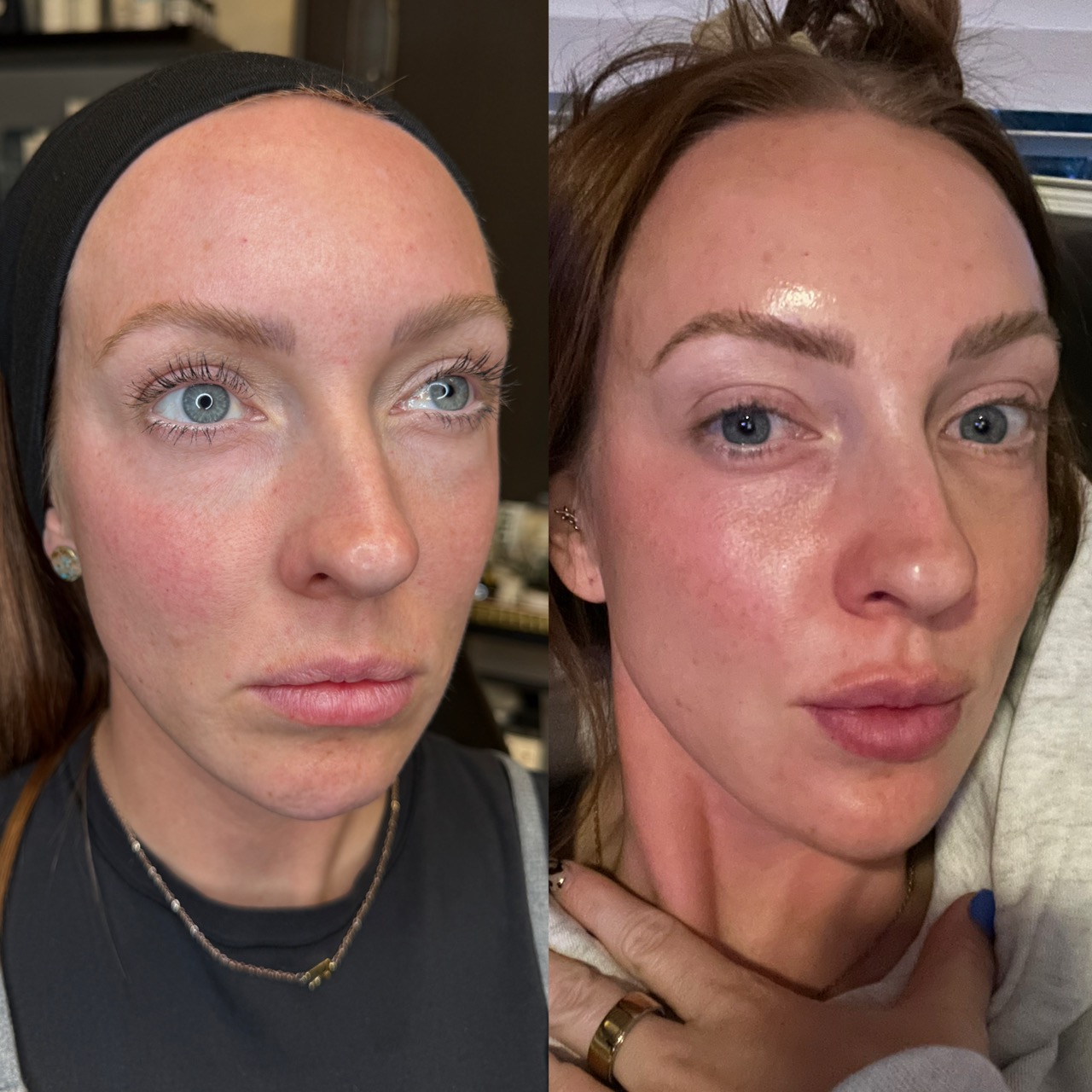Facial balancing before and after — mid-face and tear trough filler with lip framing, restored cheek support and softened under-eye hollows