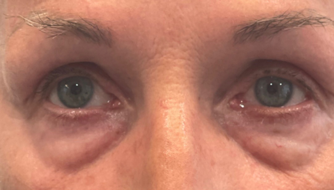 Tear trough & midface filler before and after — actual Tulua patient — before