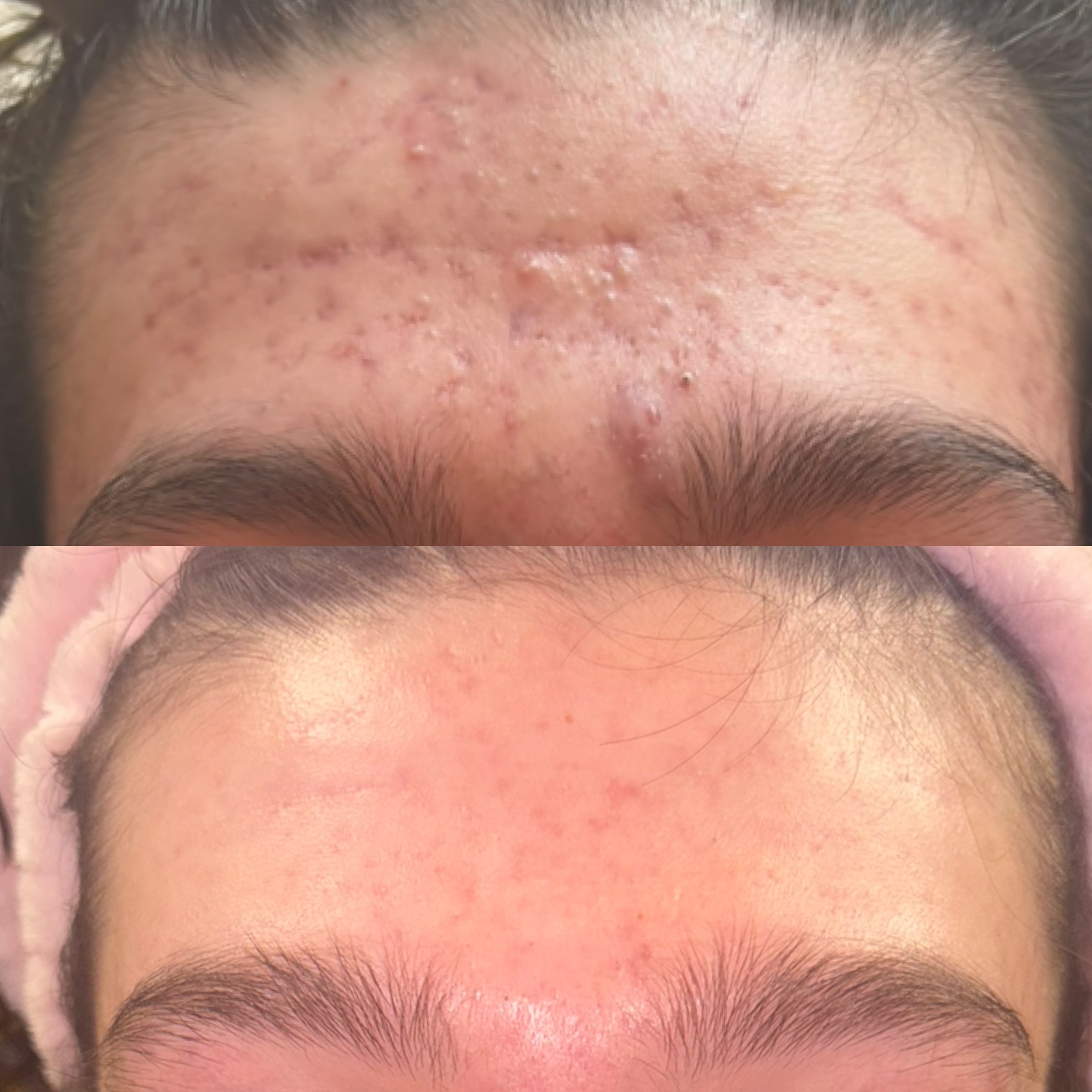 Aerolase acne before and after — forehead clearing on a female patient