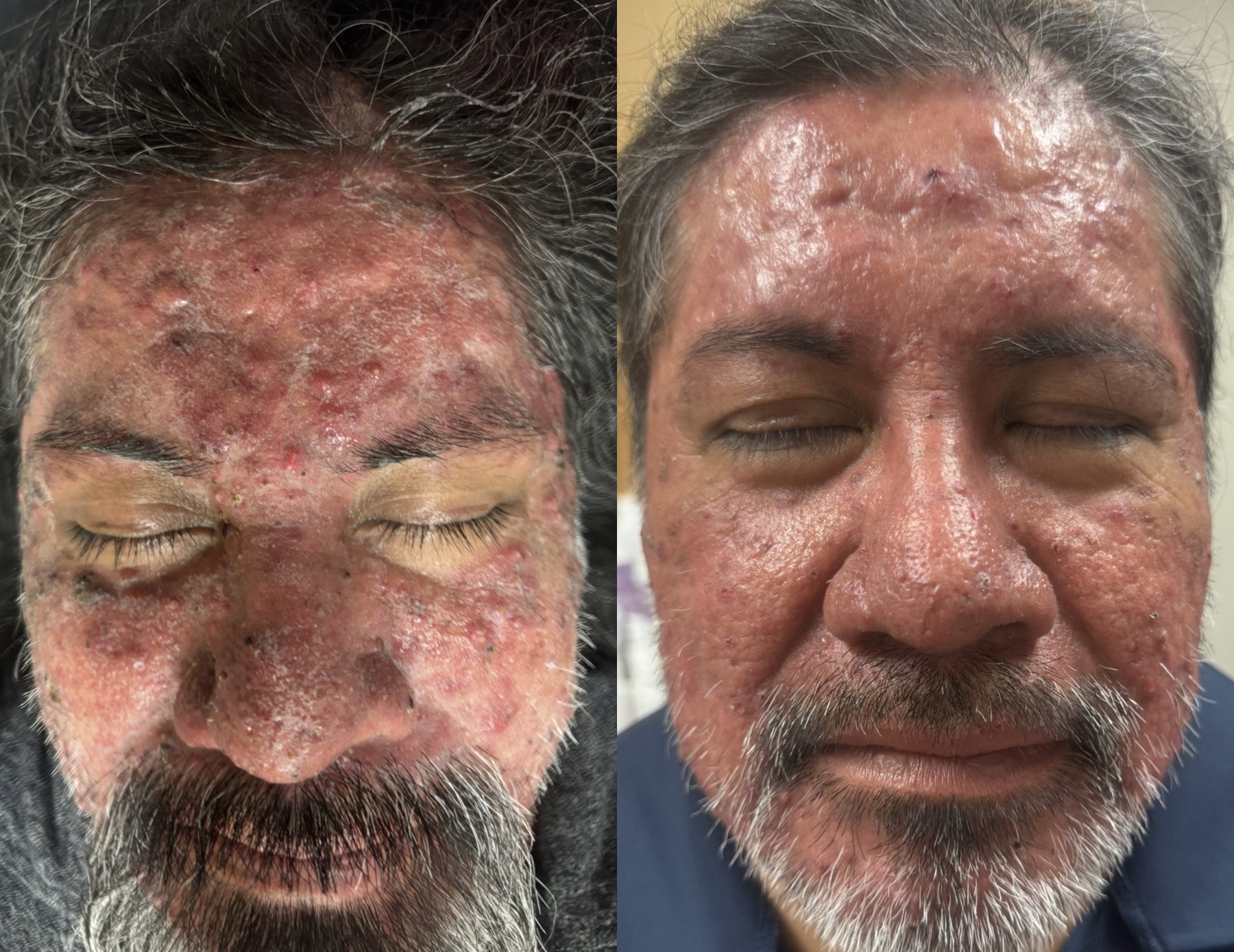 Aerolase before and after — severe cystic acne front view