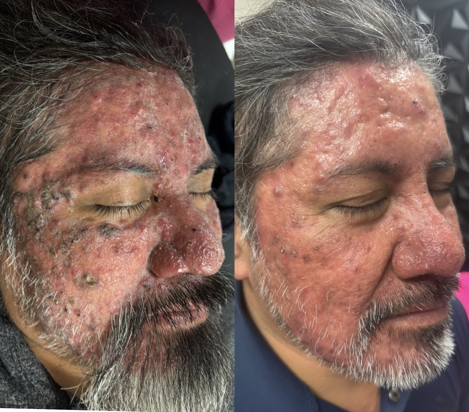 Aerolase before and after — left side profile of same patient