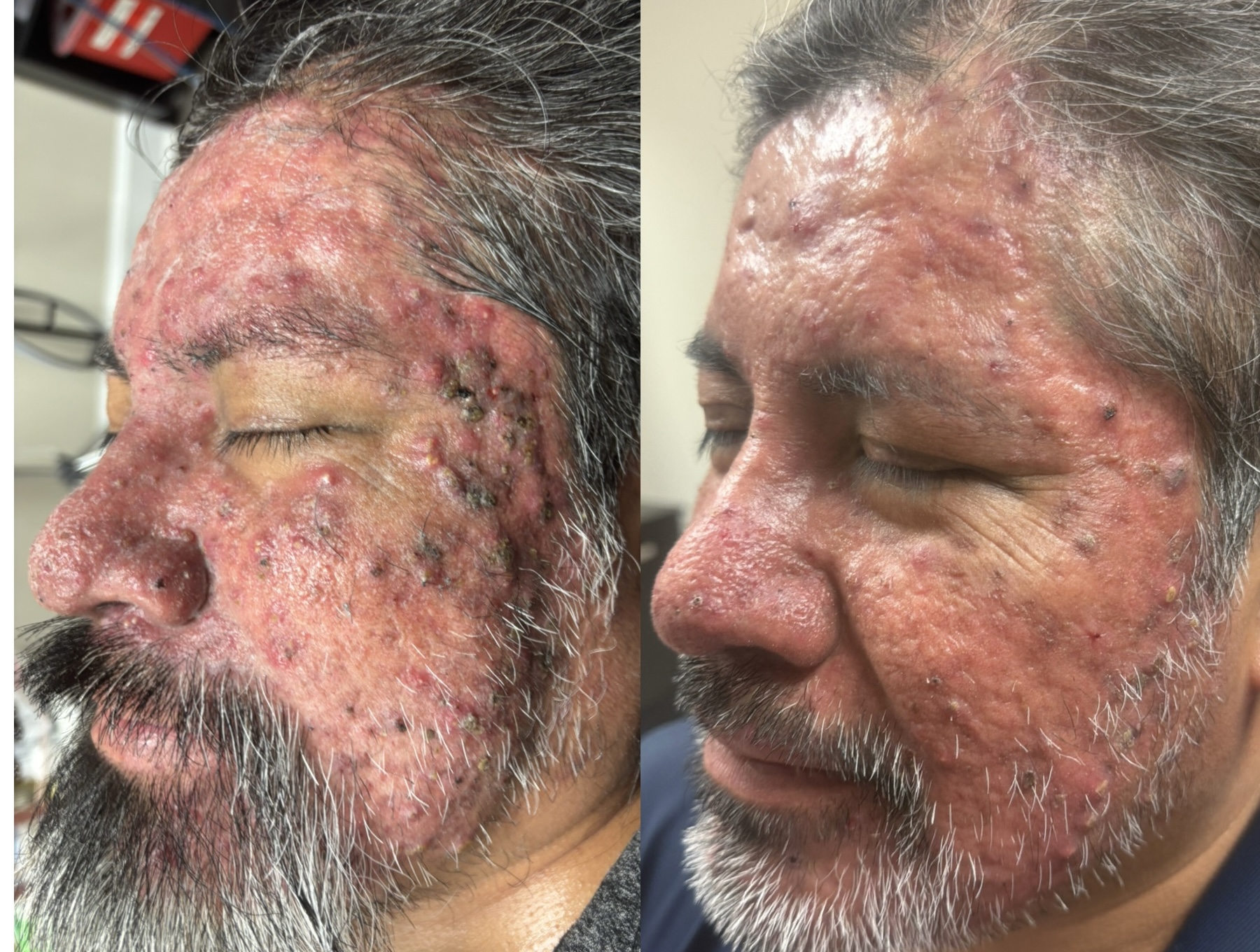 Aerolase before and after — right side profile of same patient
