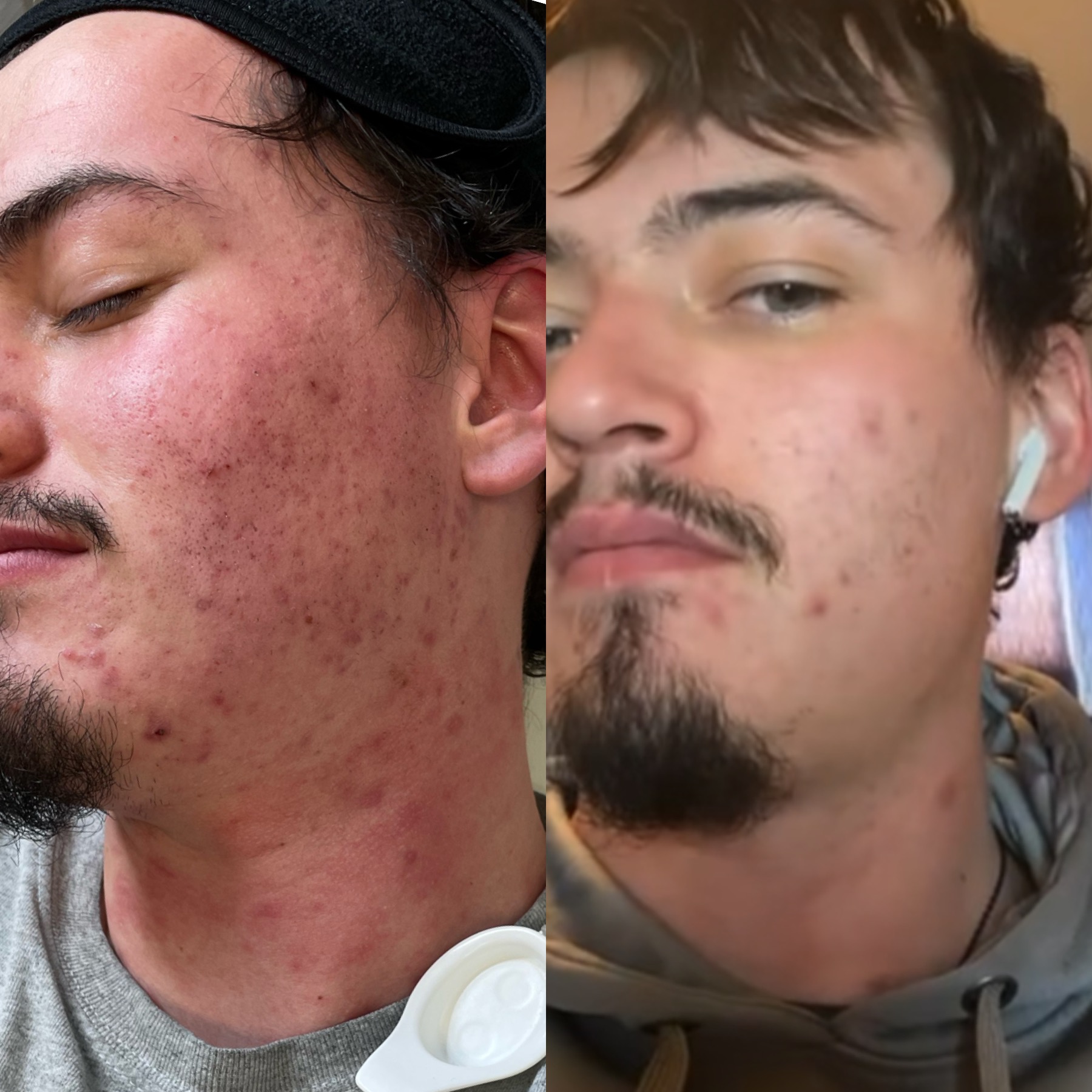 Aerolase acne before and after — male patient cheek and jawline clearing
