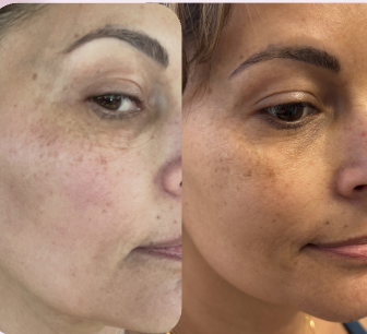 Aerolase melasma & hyperpigmentation before and after — even, brightened tone