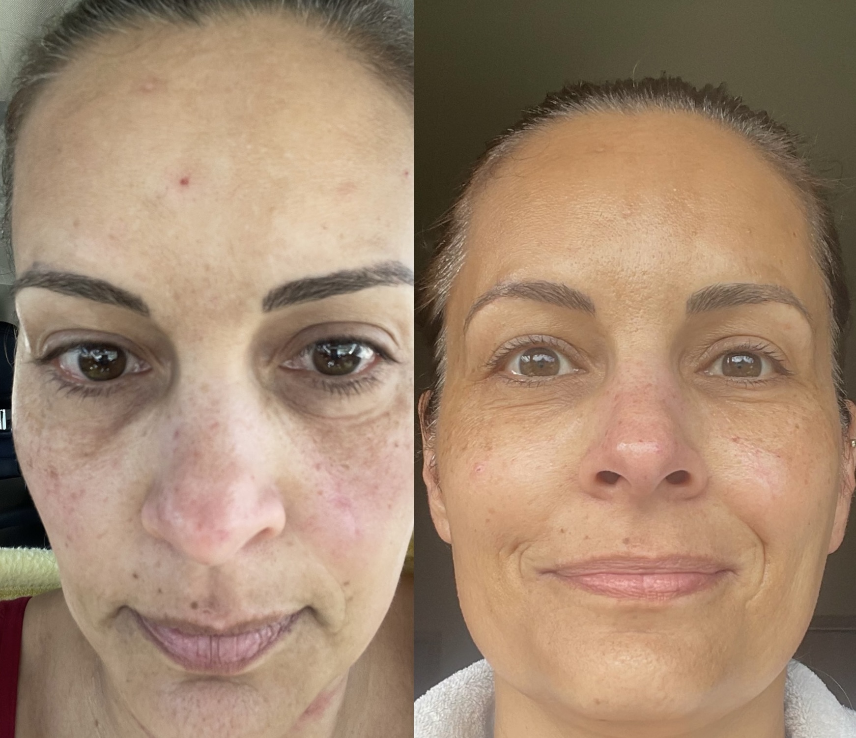 Aerolase before and after — front view of brightened, even skin