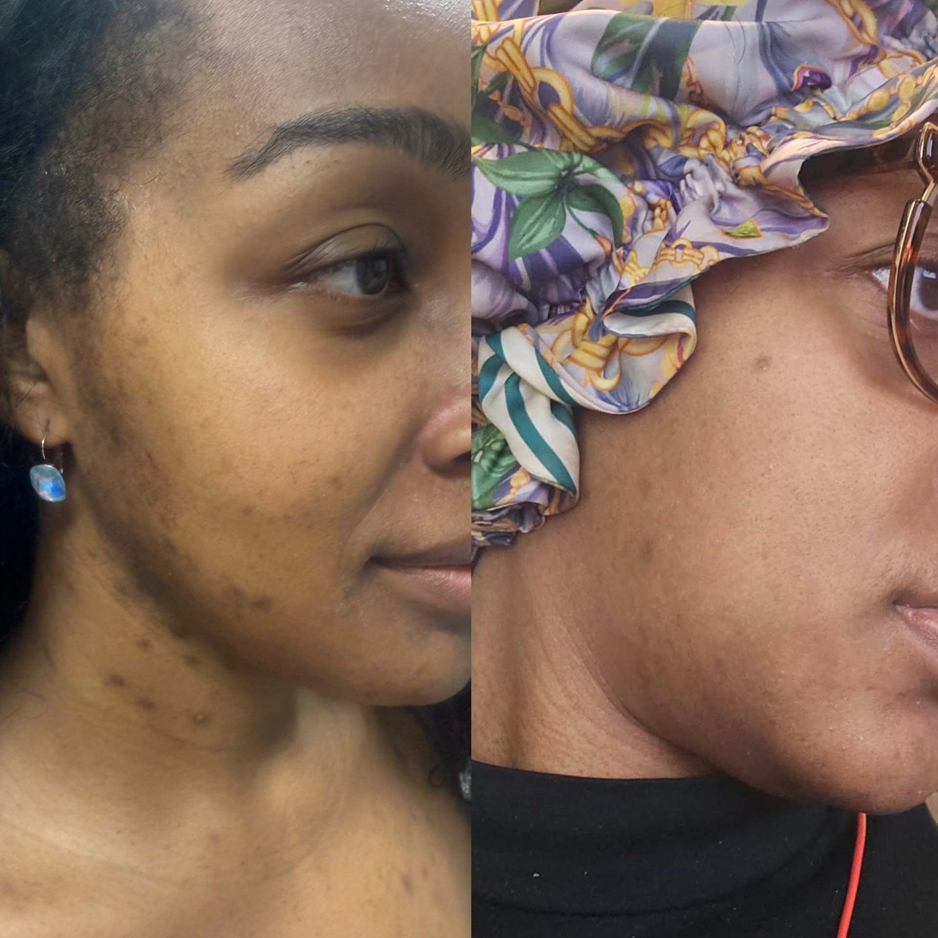 Aerolase hyperpigmentation before and after on deeper skin tone — neck & jawline clearing