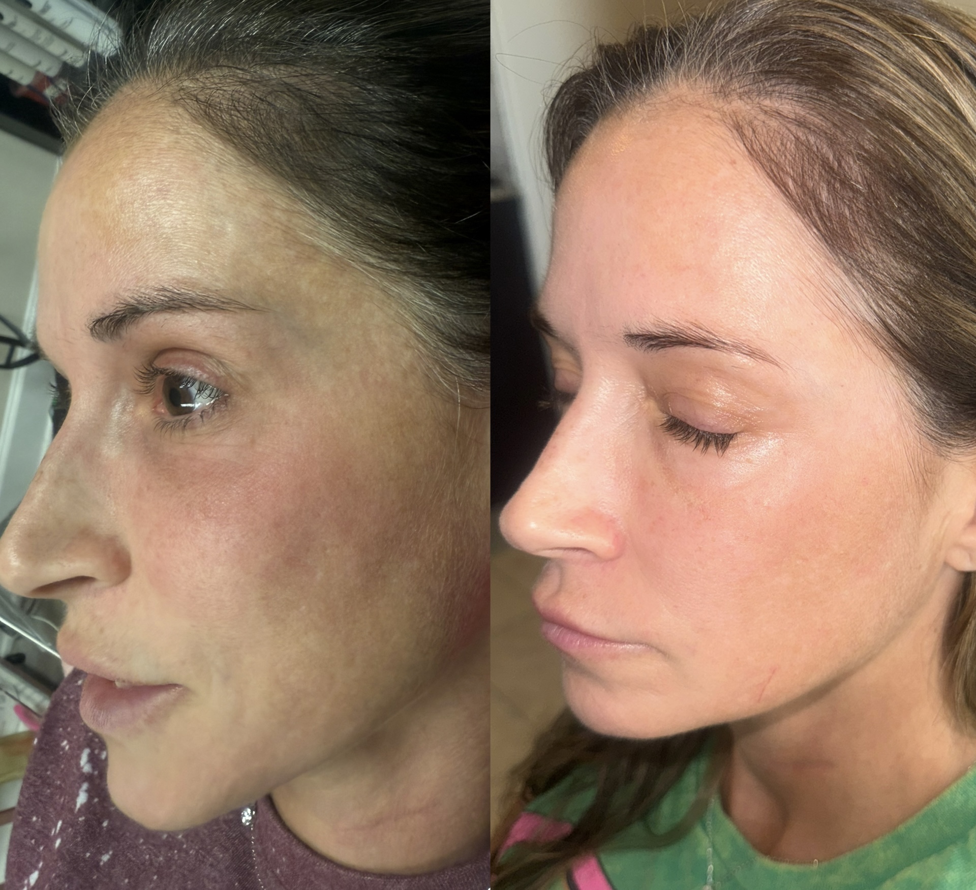 Aerolase melasma before and after — side profile clearing