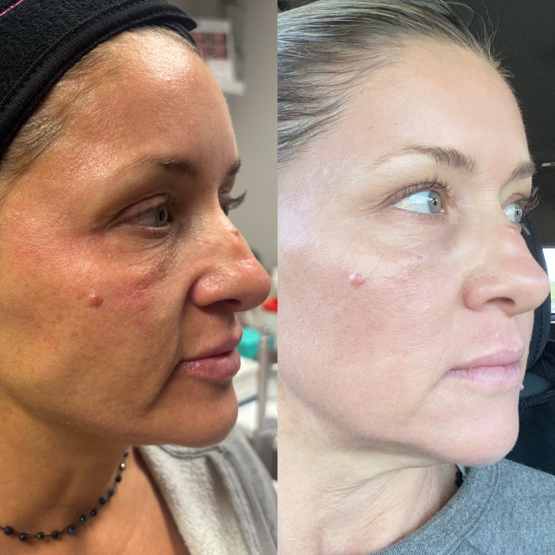 CoolPeel CO2 laser before and after — smoother texture, even tone, lifted skin at Tulua Medspa Gilbert AZ