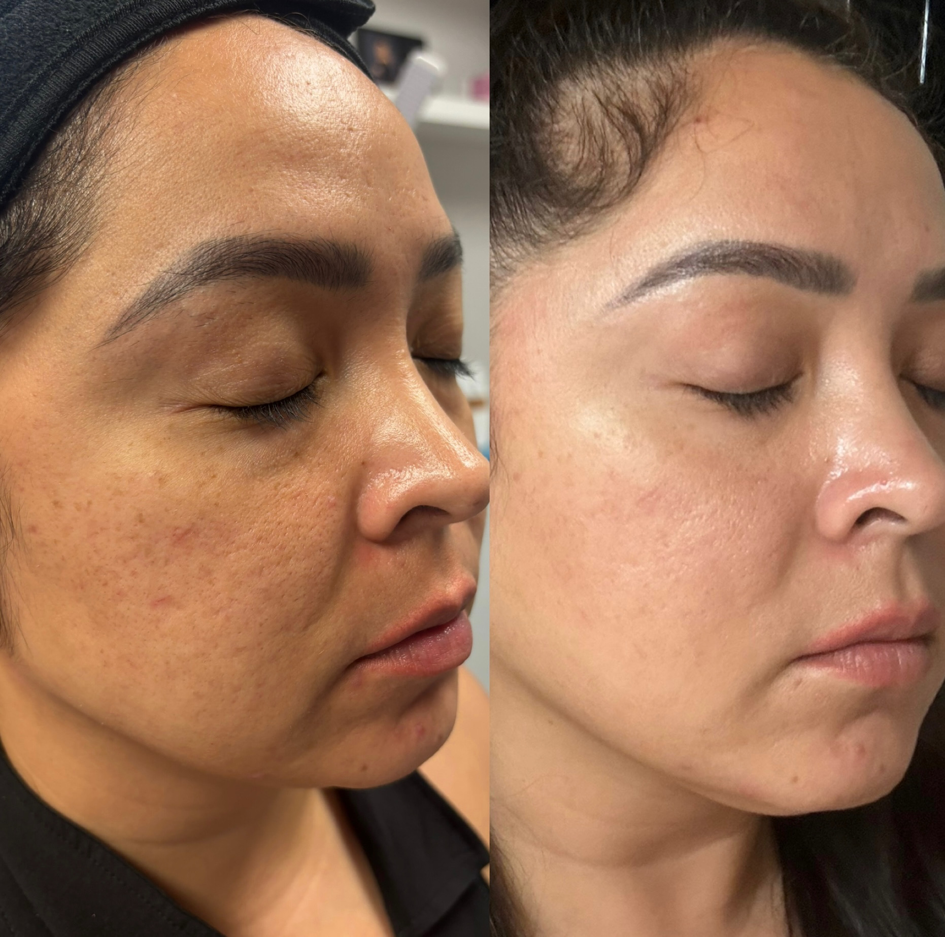 Cool peel laser before and after on Fitzpatrick IV skin — refined pores and brighter tone
