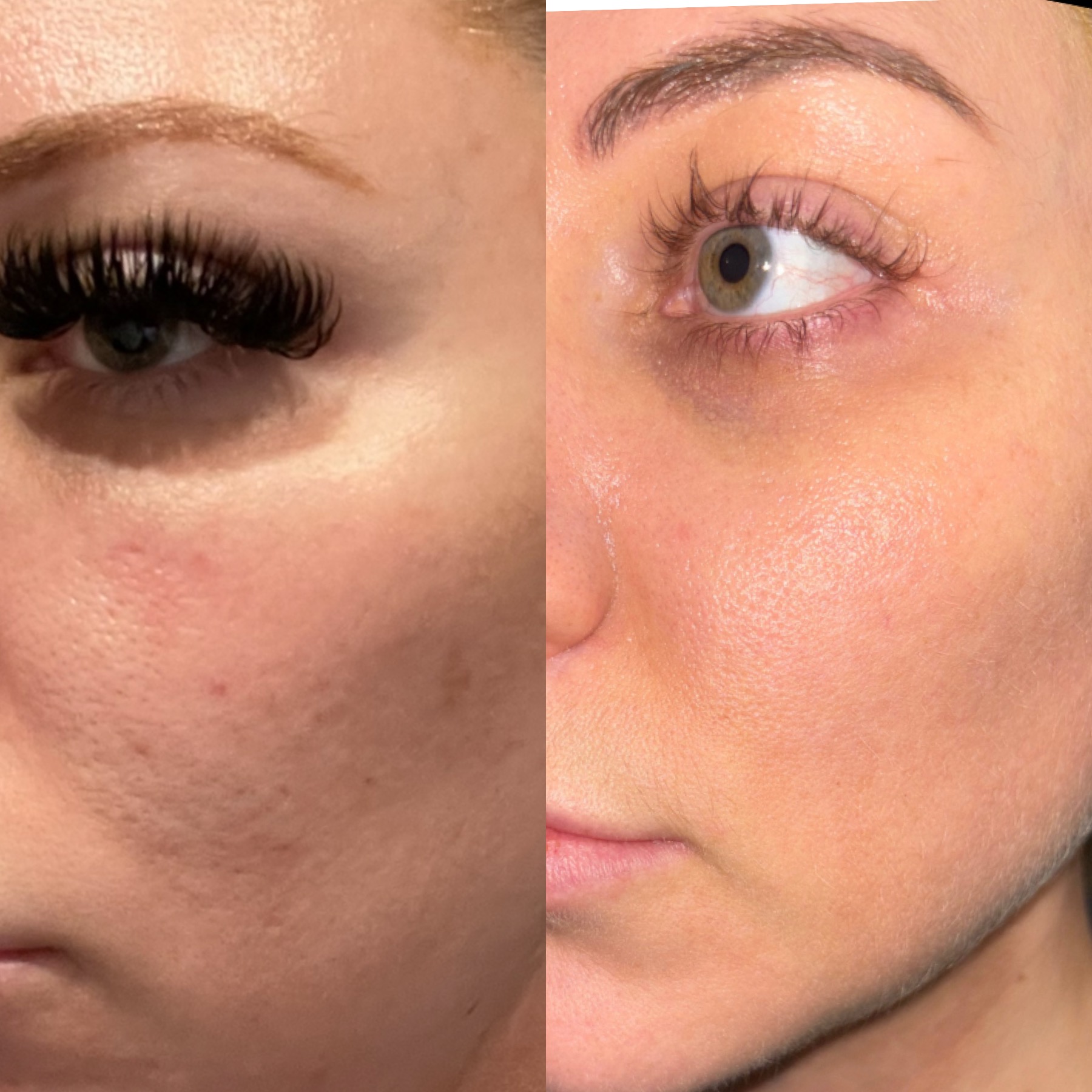 CoolPeel CO2 laser before and after for acne scars — softened atrophic scars and glassy finish