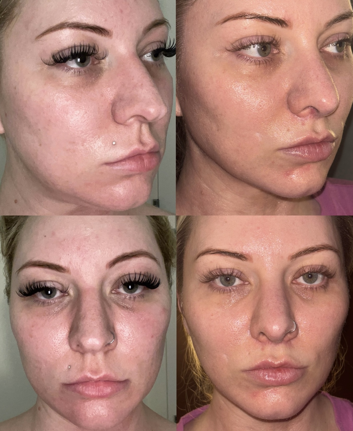 Cool peel CO2 laser multi-angle before and after — clearer, smoother skin