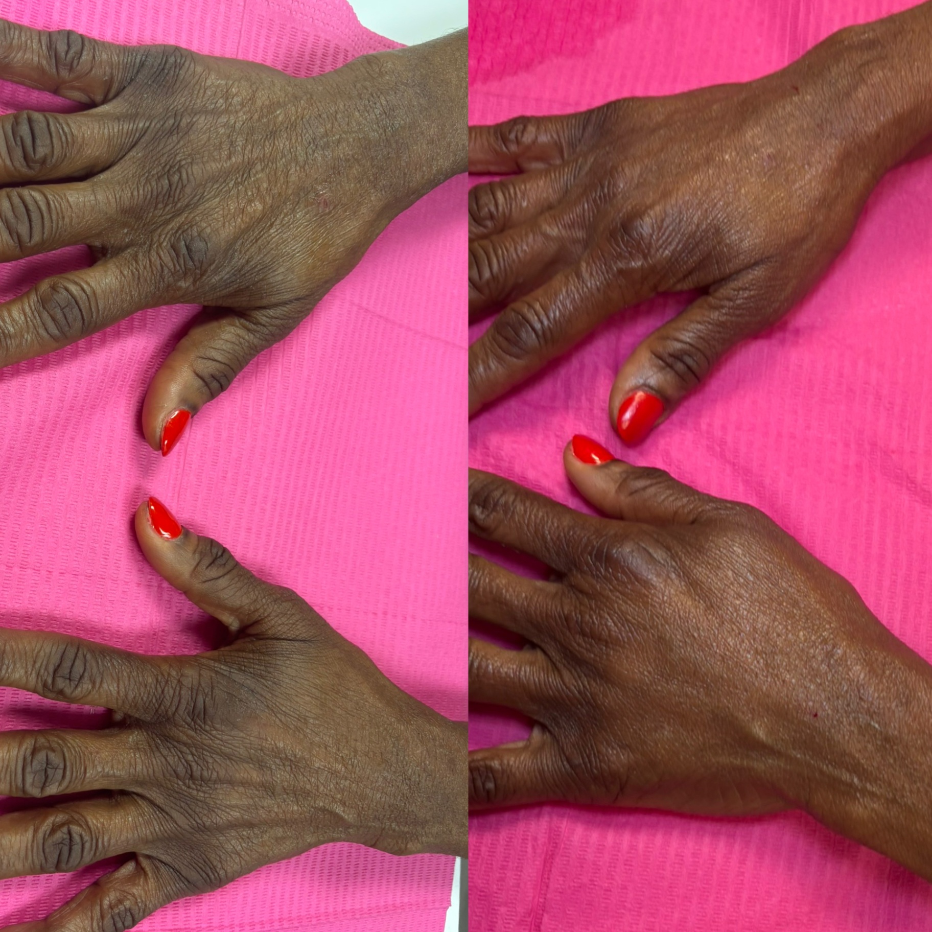 Hand filler before and after — restored volume on the back of the hands, less prominent veins and tendons