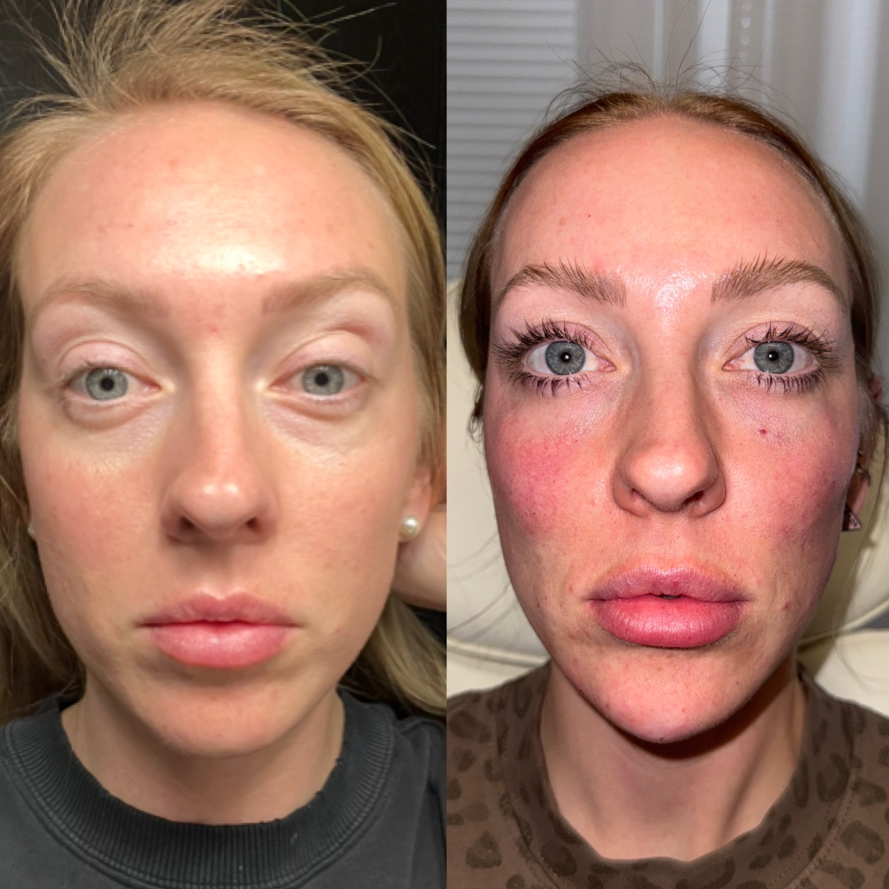 Facial balancing filler before and after — restored mid-face support, lifted cheeks and softer under-eye hollows