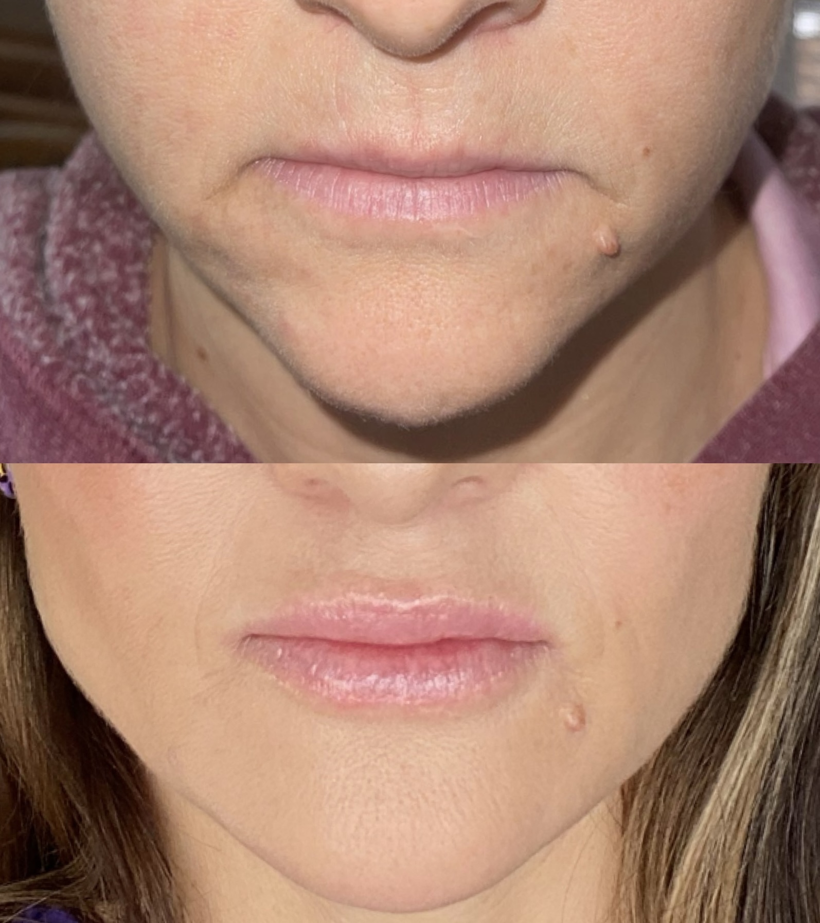 Chin and lower-face filler before and after — smoother chin, defined jawline and balanced lip proportion