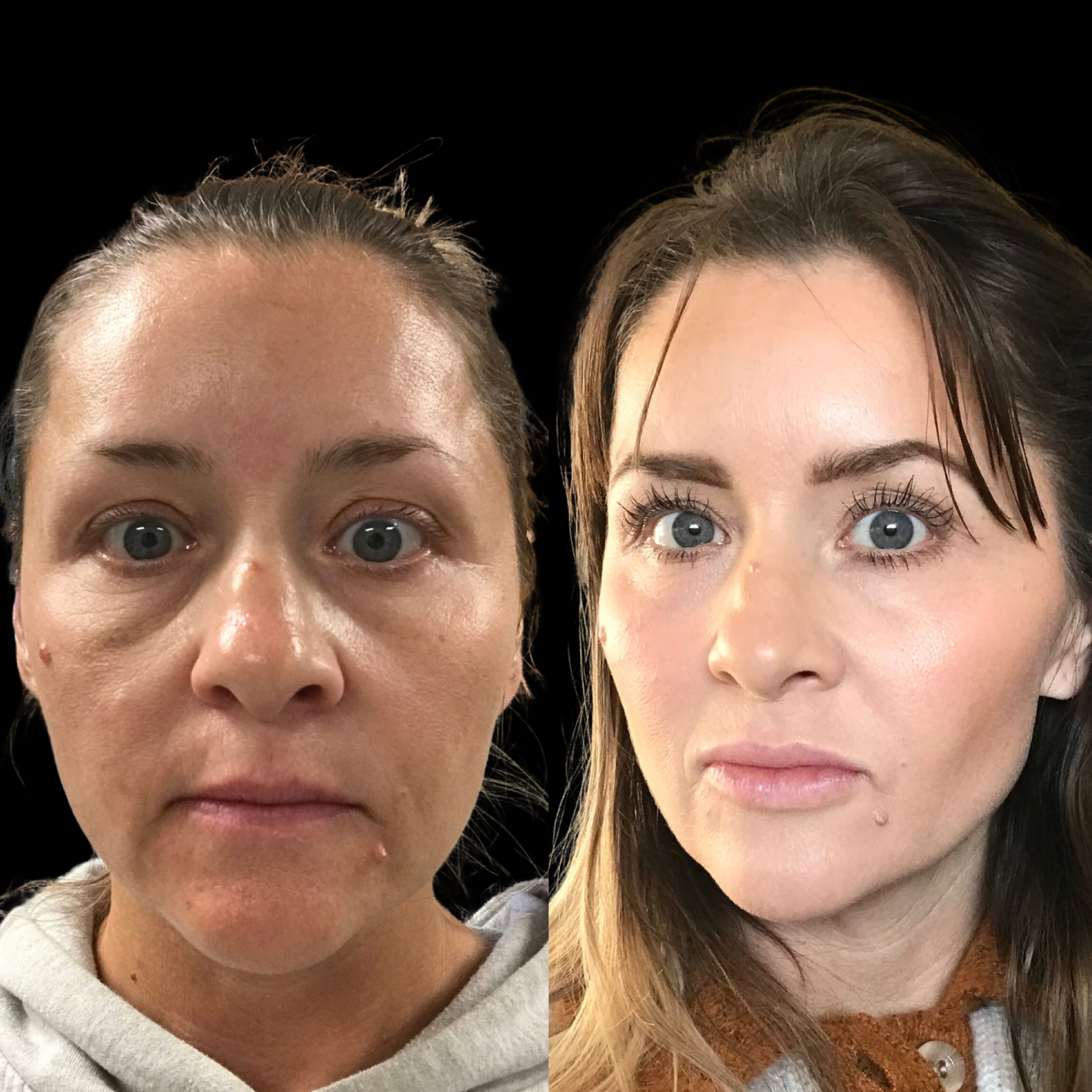 Facial balancing before and after — lifted cheeks, refreshed under-eyes and restored facial harmony