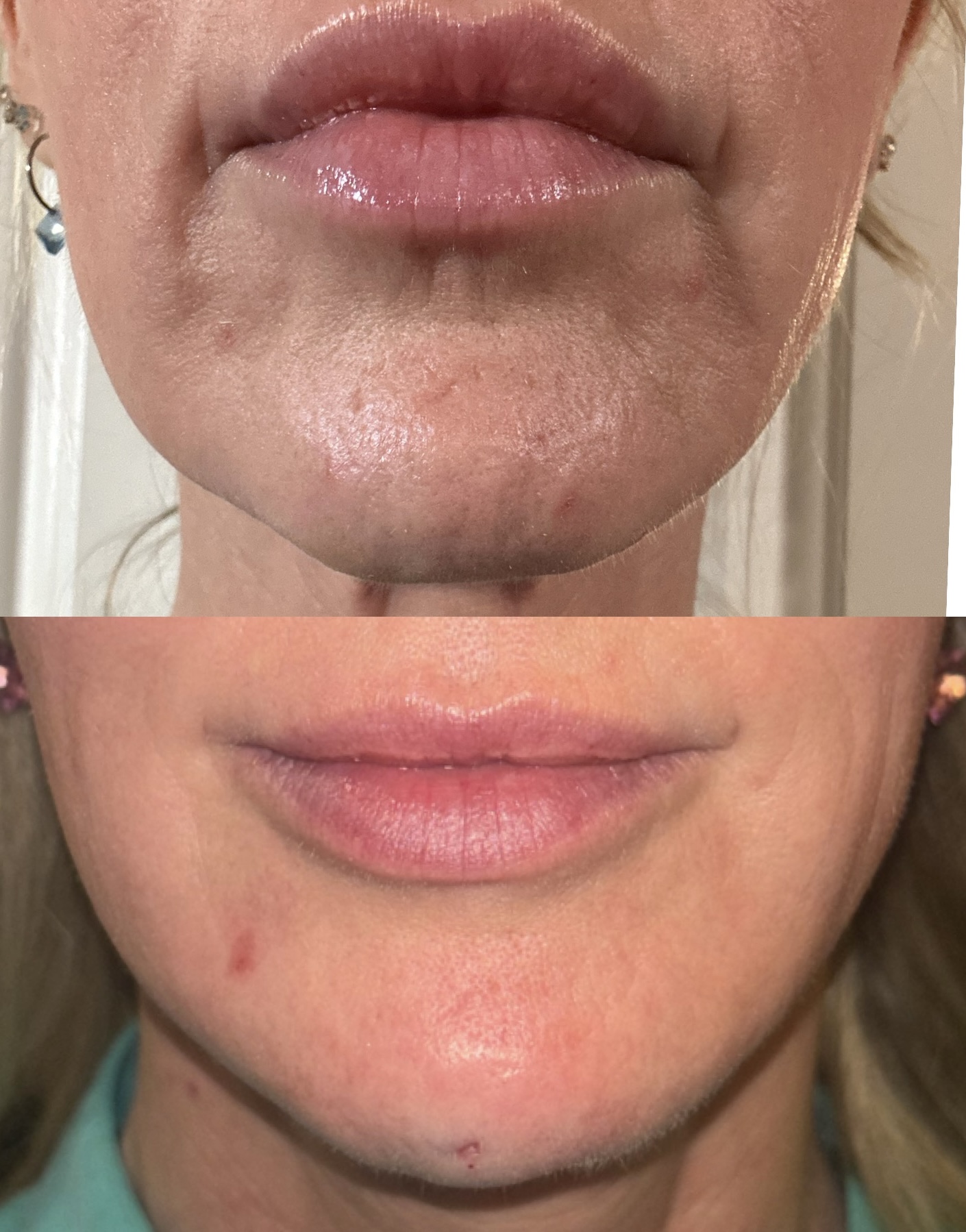 Lower face and chin filler before and after — projected chin, balanced lower-face proportions and refined lip shape