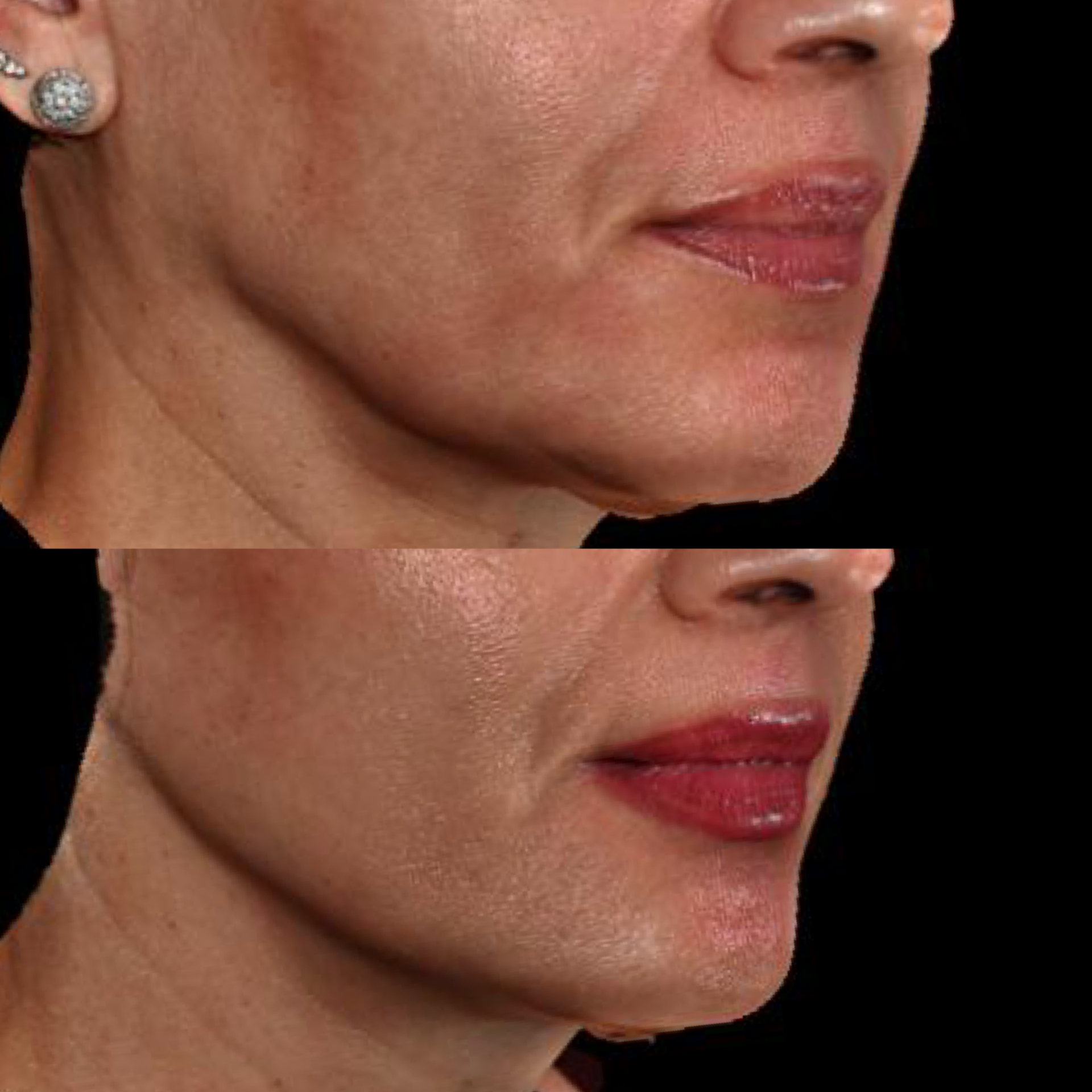 Jawline filler before and after — sharper jaw definition, smoother chin and softened marionette lines