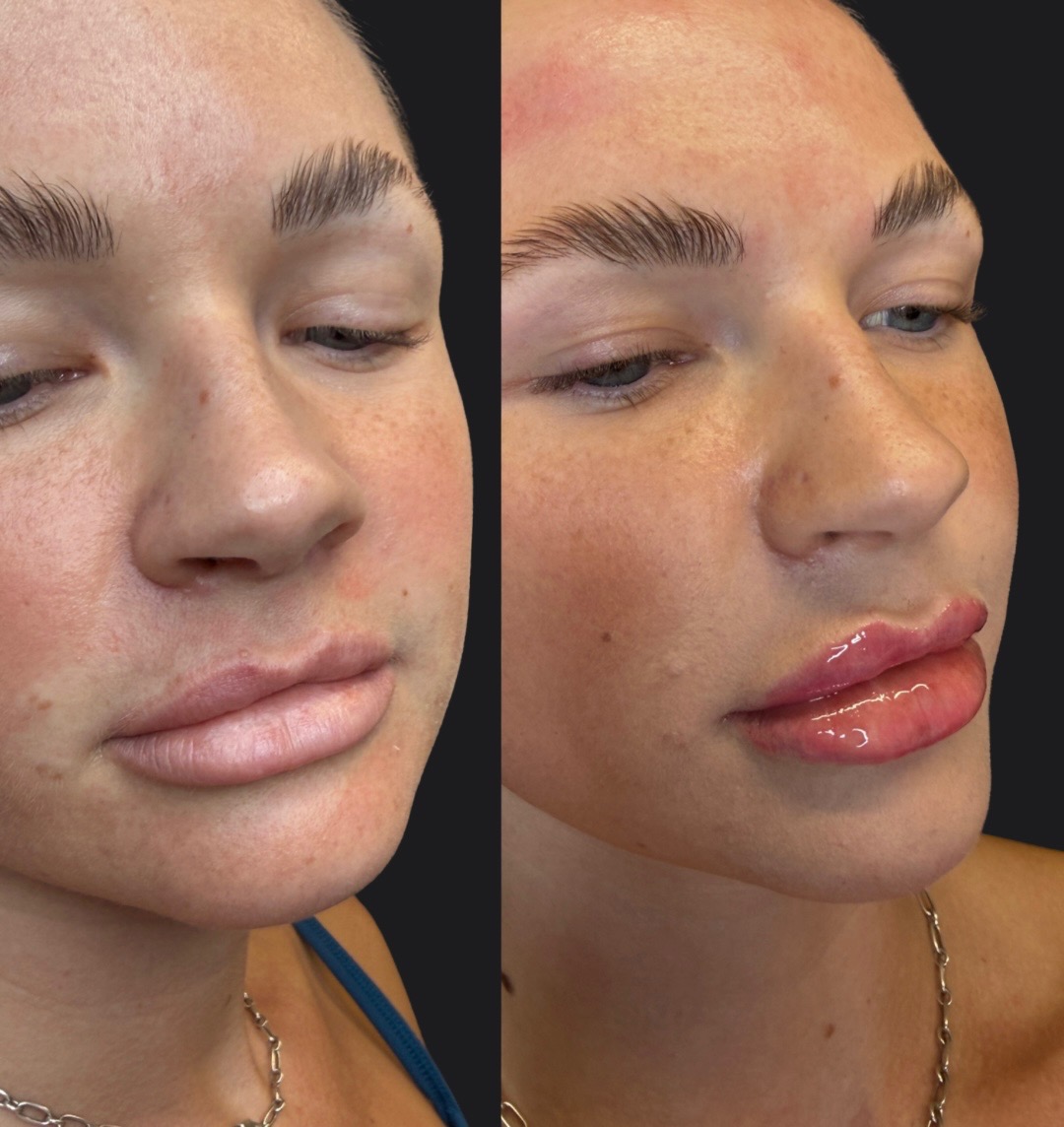 Lip filler before and after — restored lip volume, refined cupid's bow and softer lower-face contour