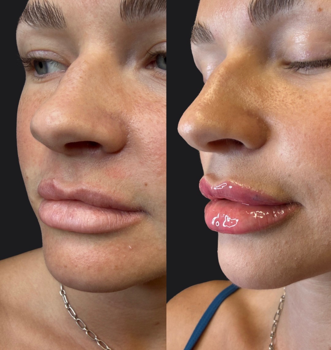 Lip filler before and after — fuller, plumper lips with balanced proportions and a glossy, hydrated finish