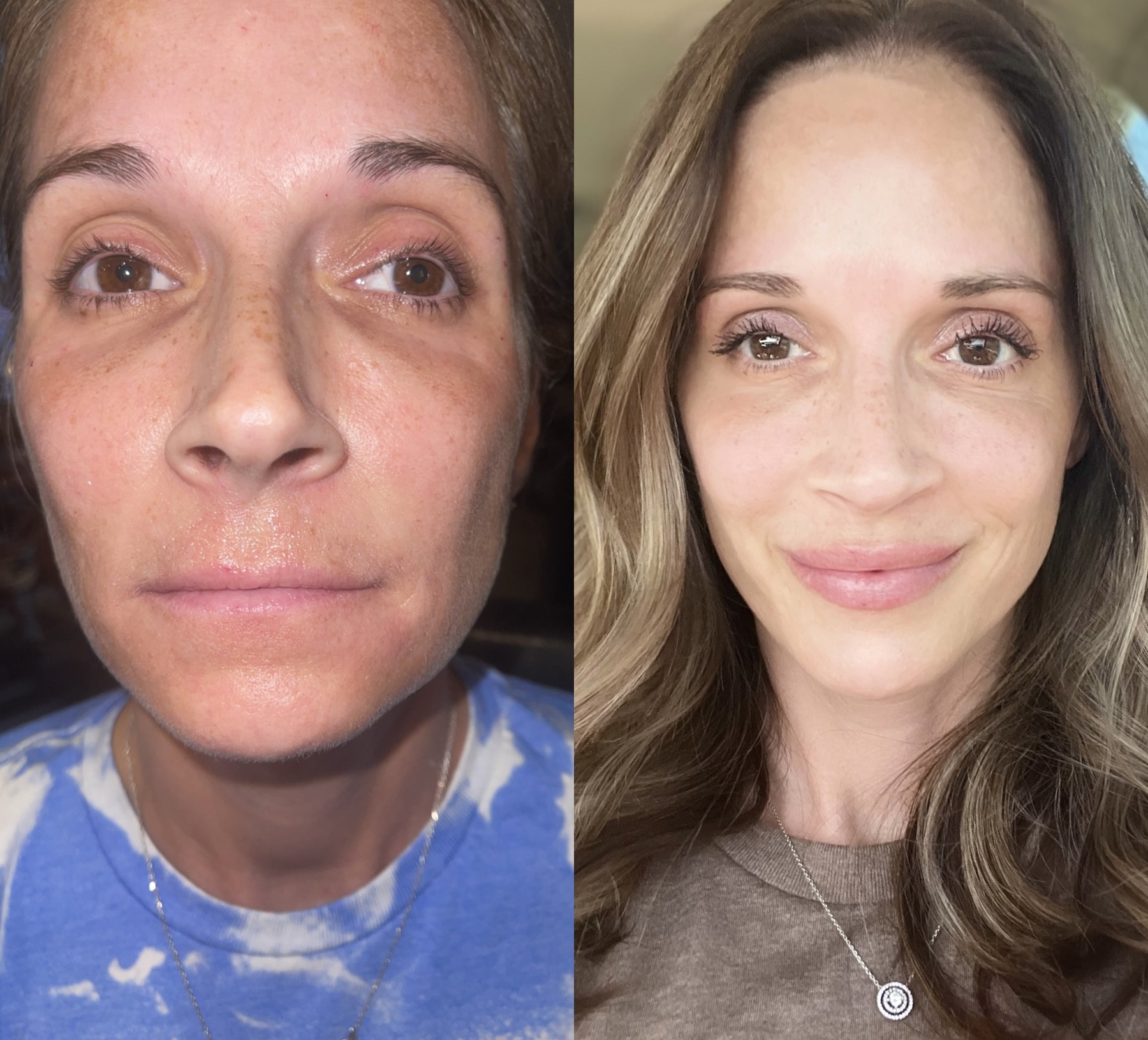 Lip filler before and after — natural, hydrated lip enhancement by Shantel White, DNP at Tulua Medical in Gilbert, AZ