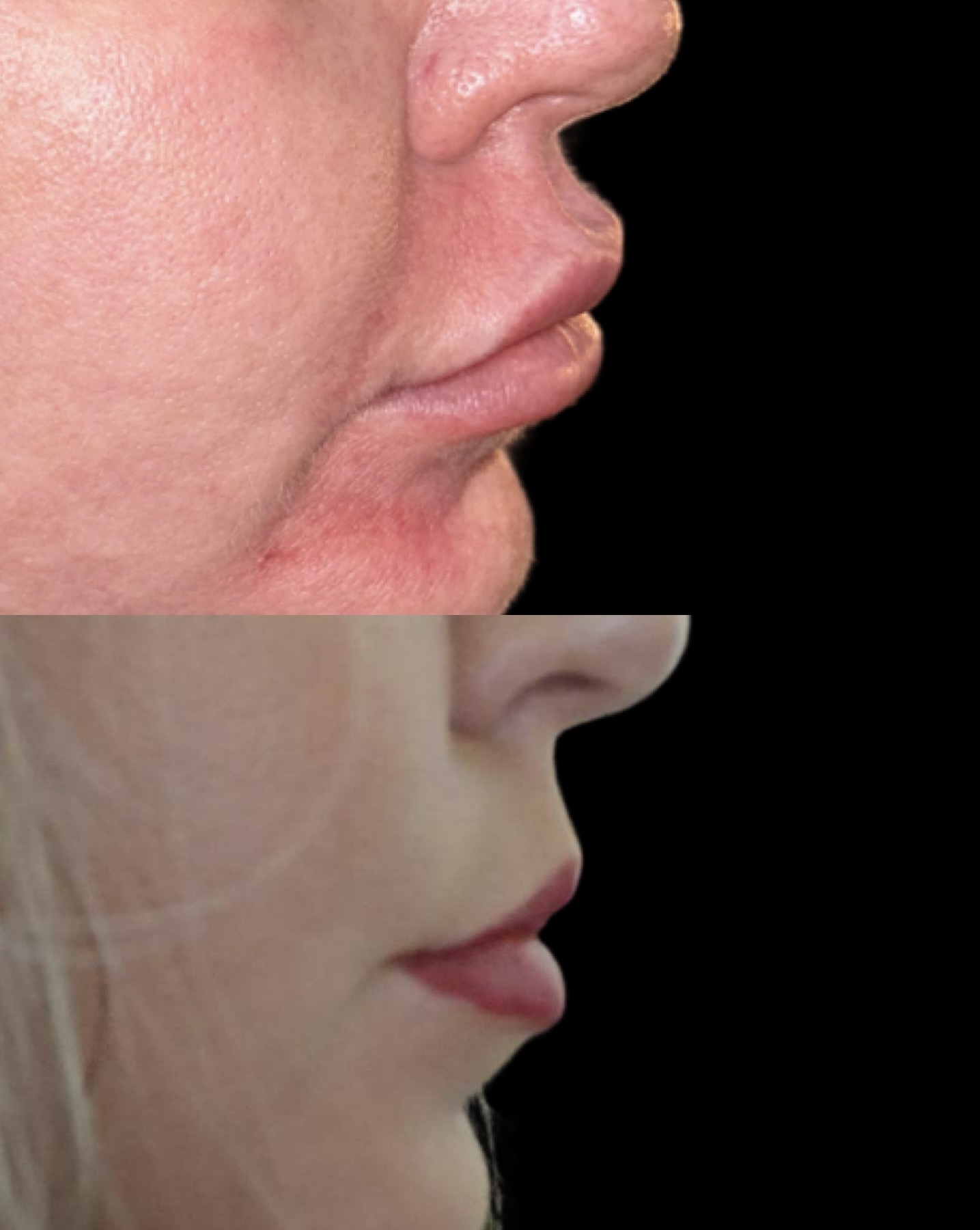 Lip rehab before and after — migrated filler dissolved with hyaluronidase, restored natural lip border and shape