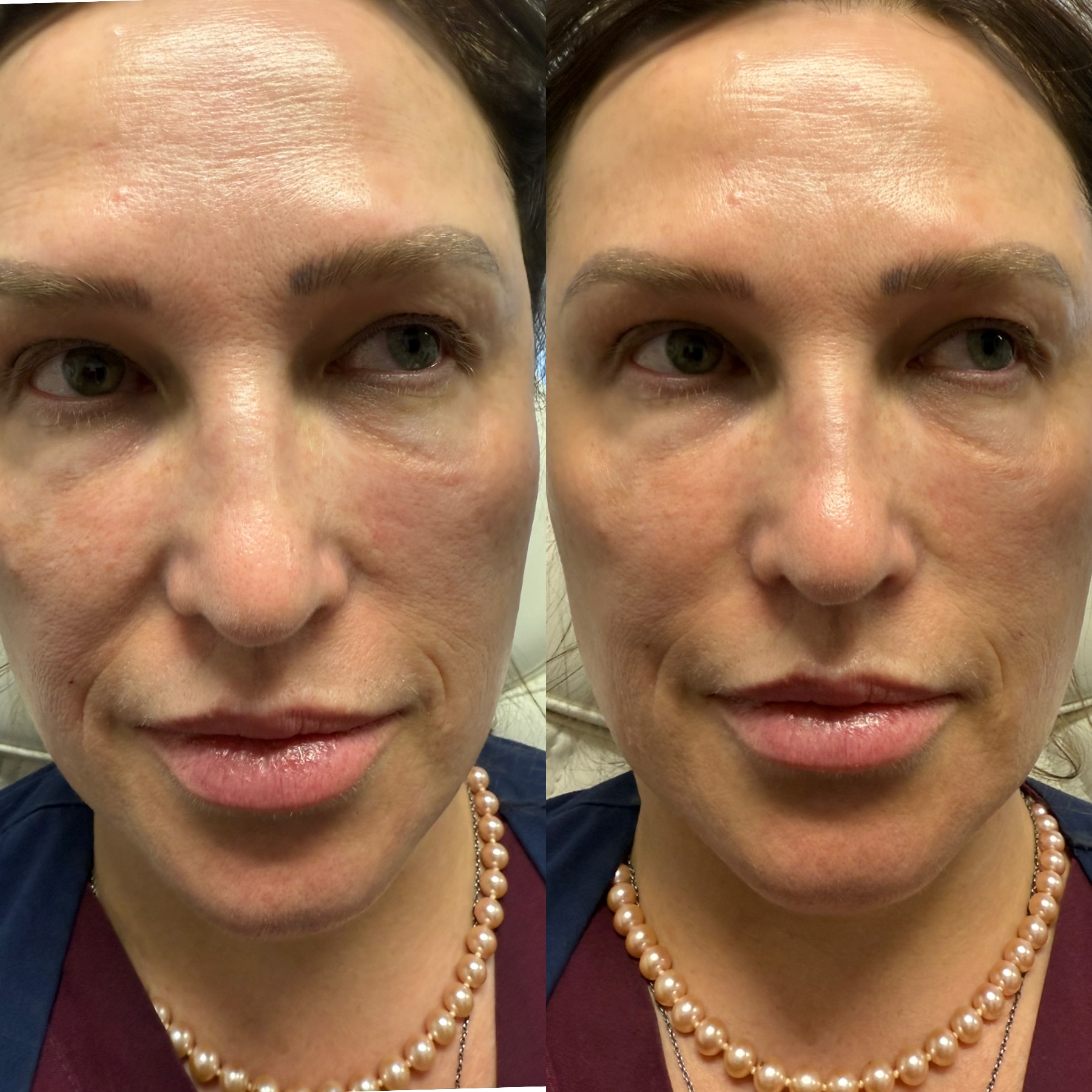 Nasolabial fold filler before and after — softened smile lines and smoother midface contour