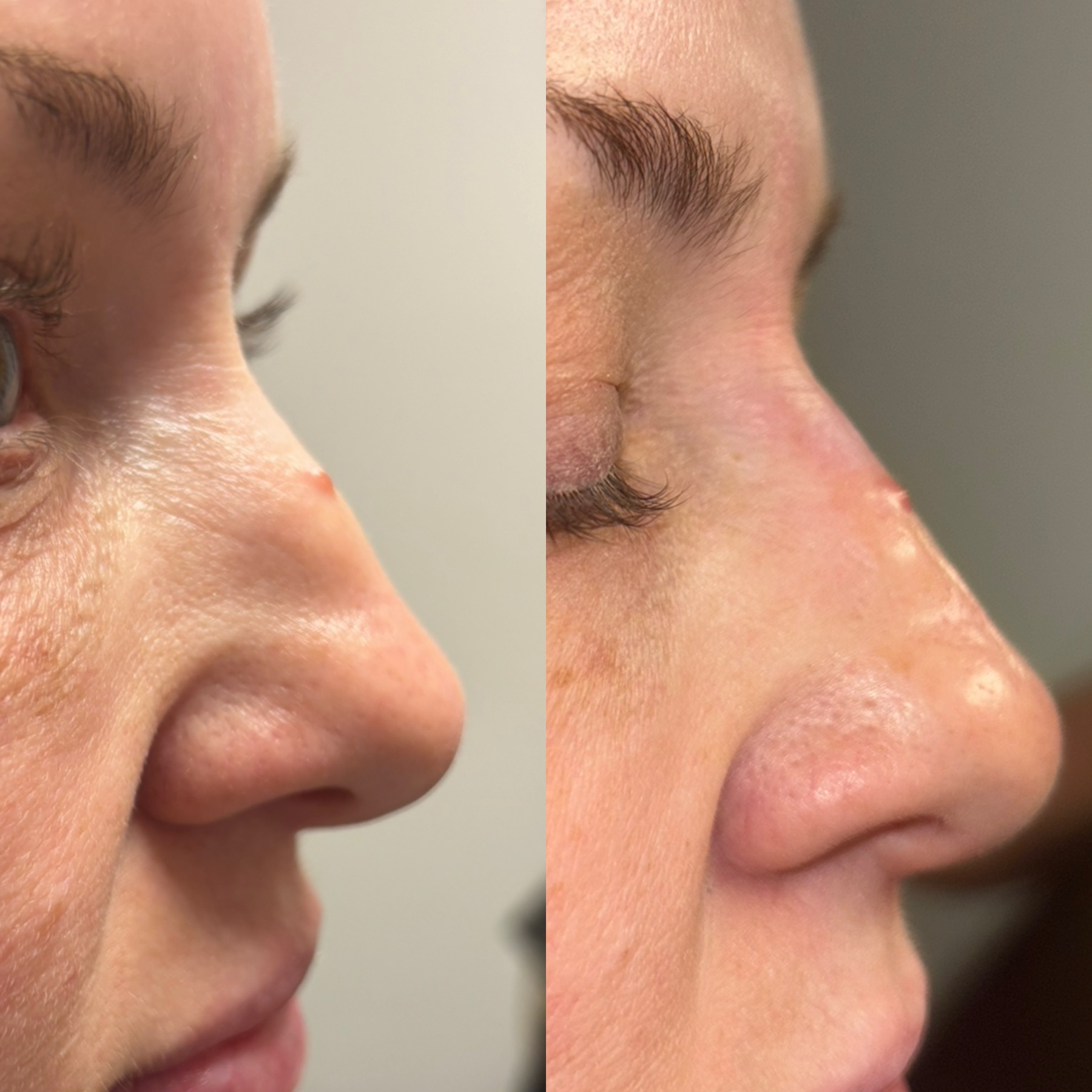 Nonsurgical nose filler before and after — smoothed dorsal hump and refined, straighter side profile