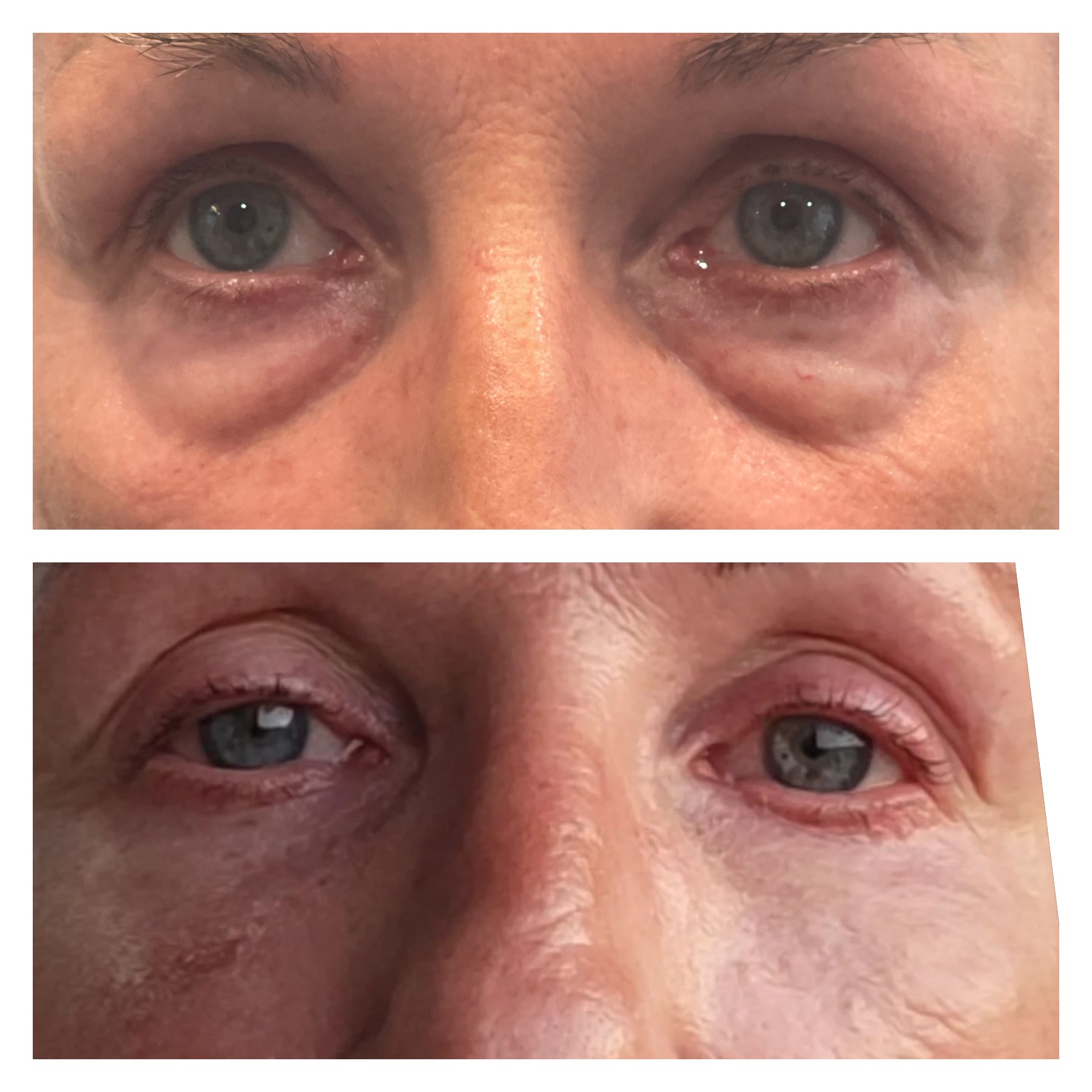 Under-eye treatment before and after — reduced puffiness, smoother tear trough and brighter, more rested under-eye area