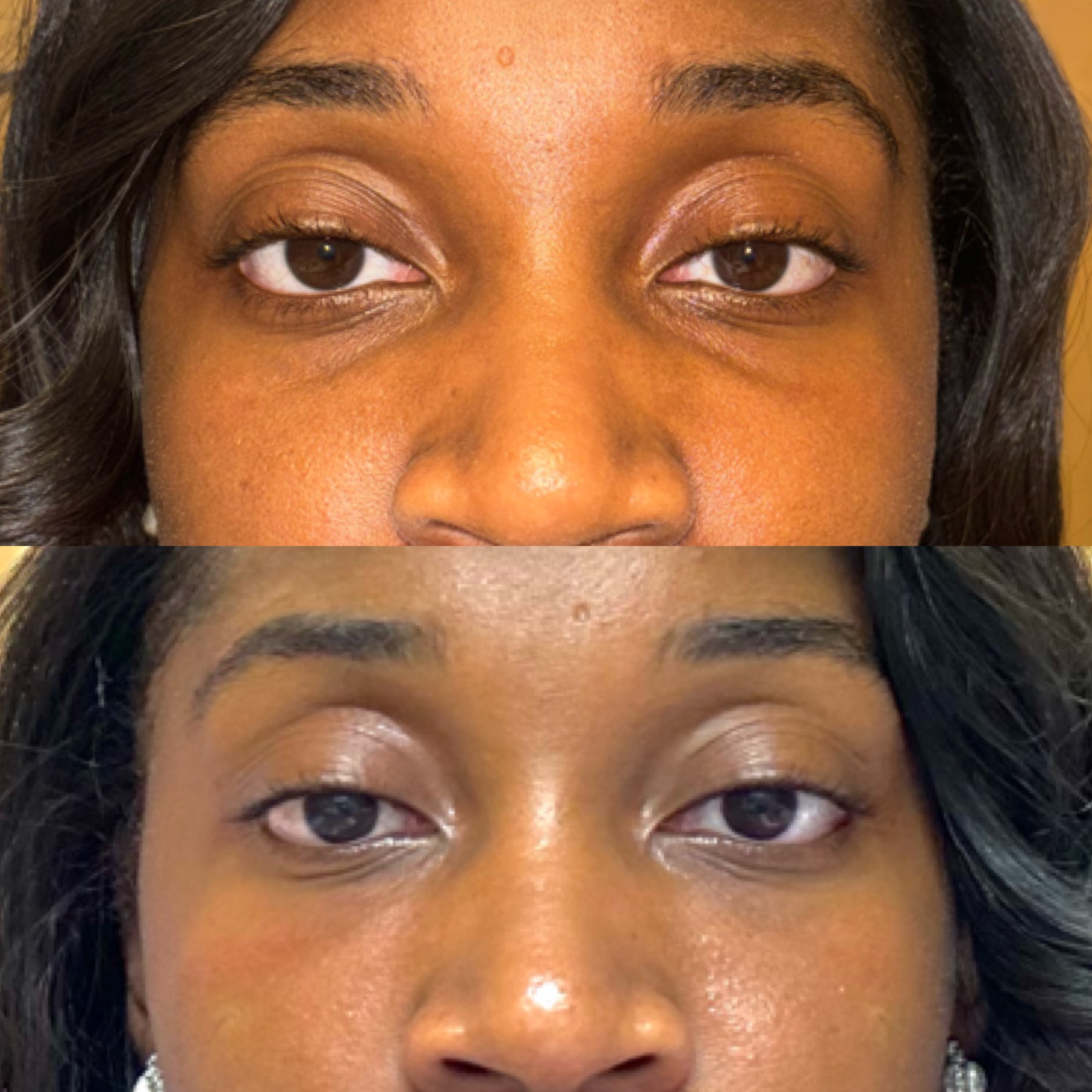 Tear trough filler before and after — smoothed under-eye hollows and refreshed, even contour