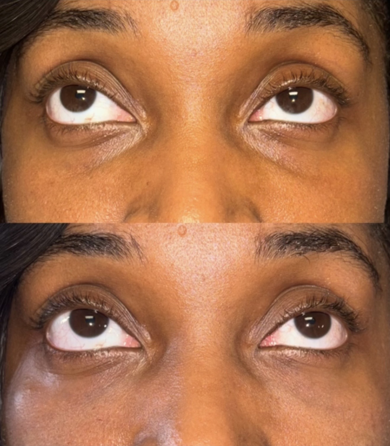 Under-eye tear trough injectables before and after — diminished shadows and a brighter, well-rested appearance