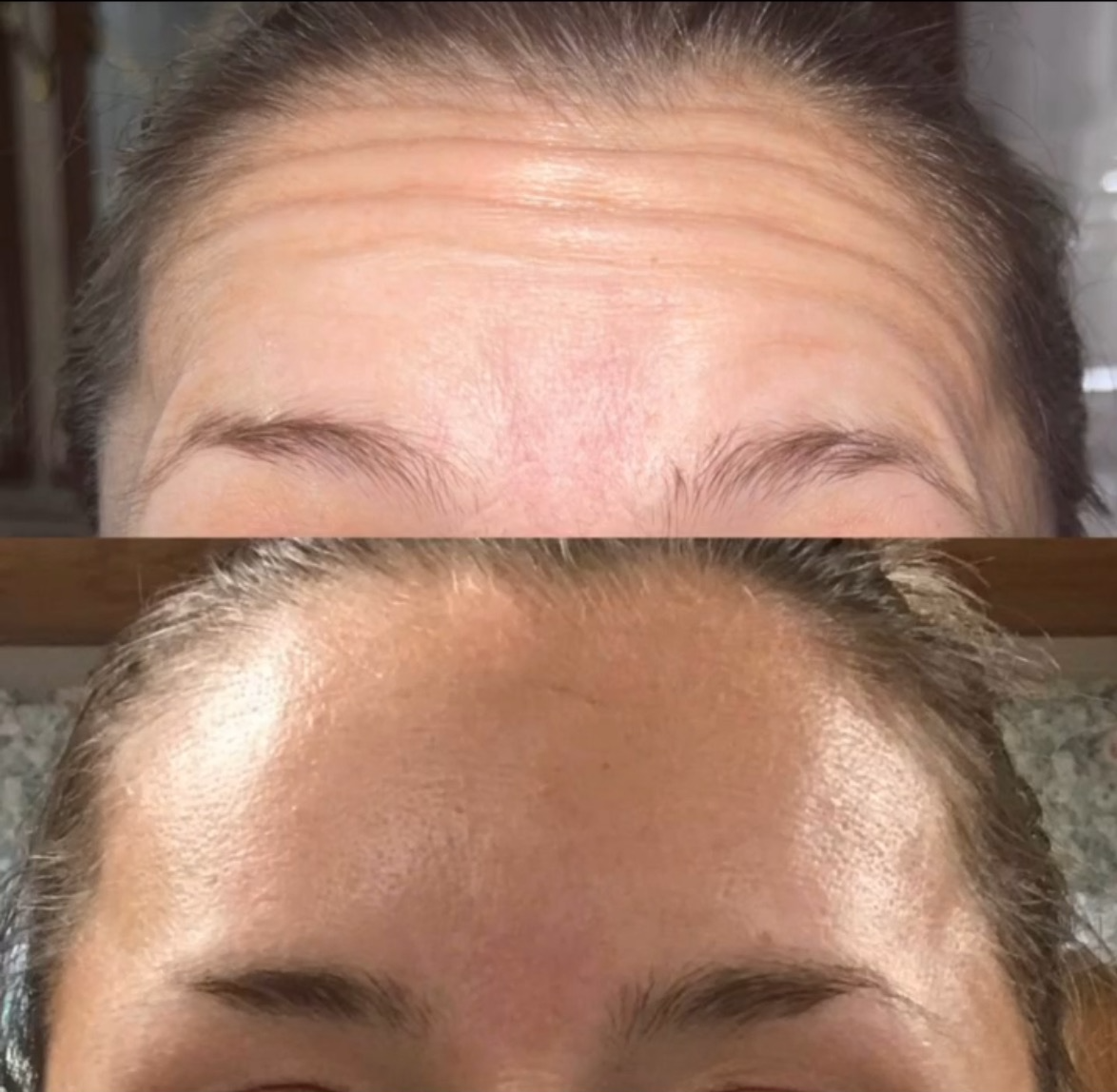 Neurotoxin before and after — softened forehead lines with natural brow position preserved
