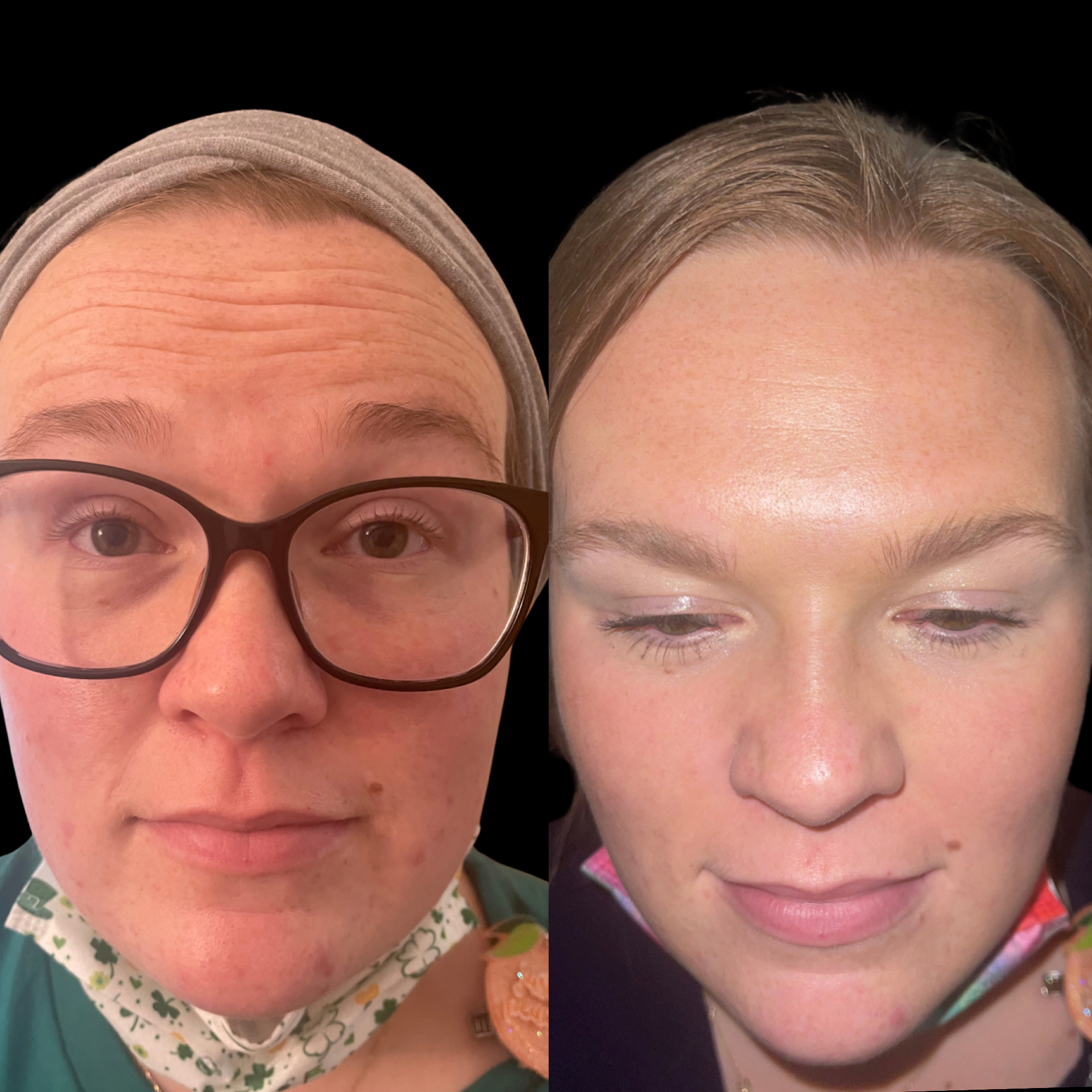 Neurotoxin before and after — smoother glabella and forehead with natural expression retained